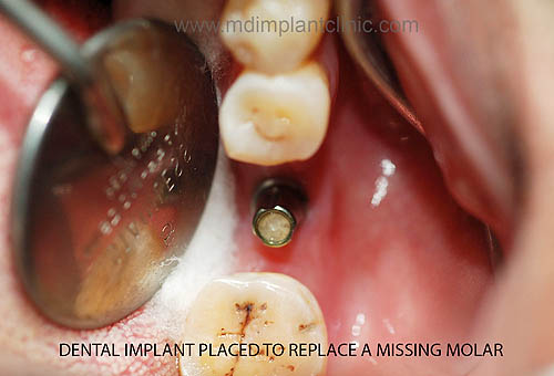 Mother Dental Implant Clinic