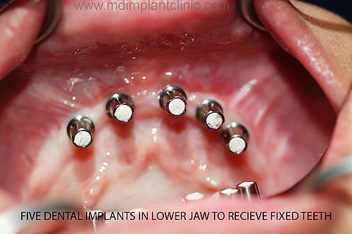 Mother Dental Implant Clinic