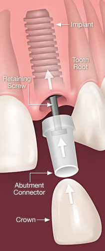 Mother Dental Implant Clinic