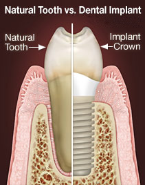 Mother Dental Implant Clinic